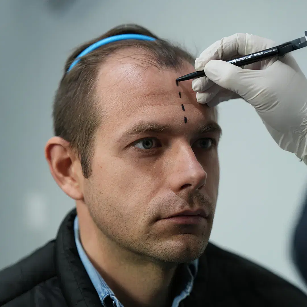 Before Hair Transplant