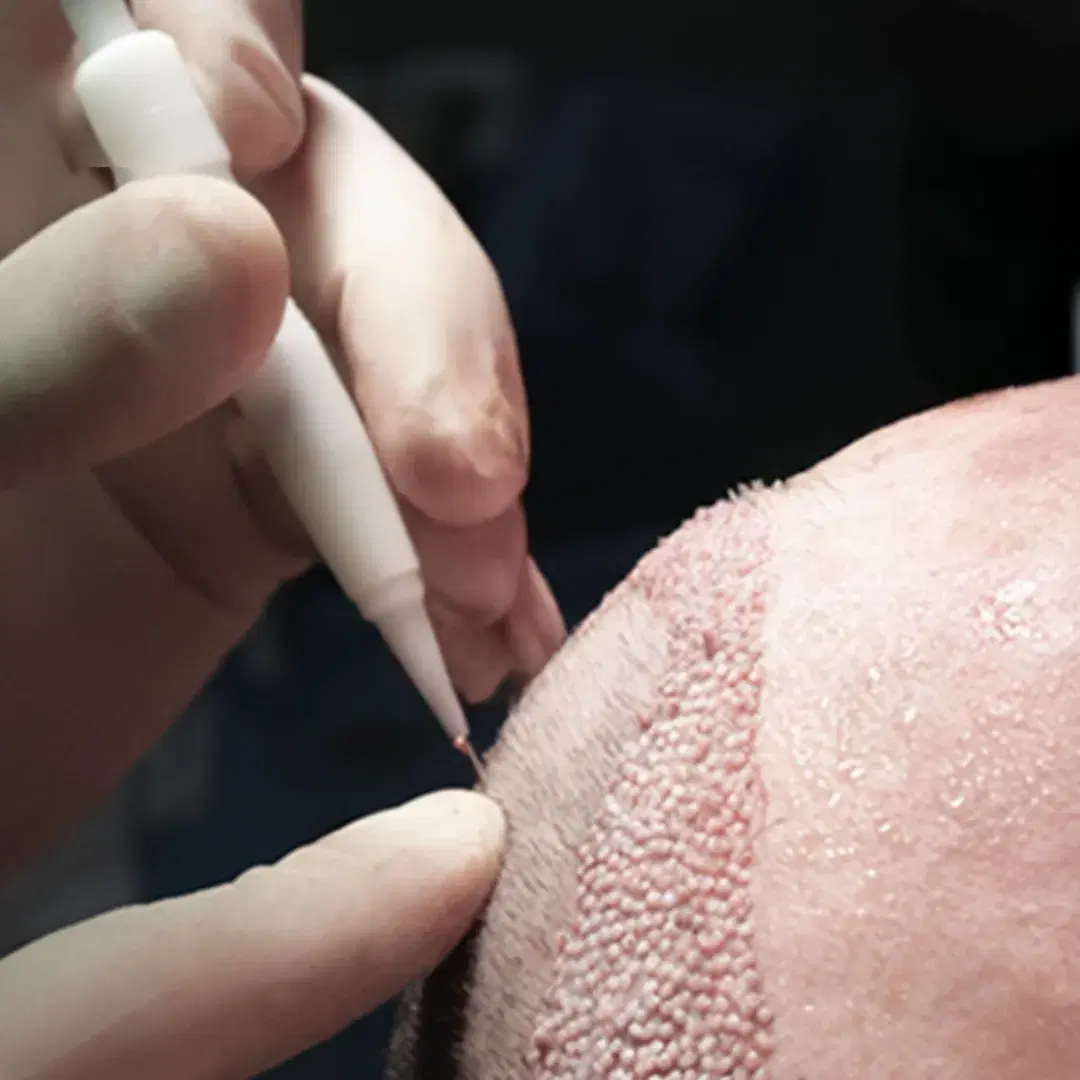 DHI Hair Transplant
