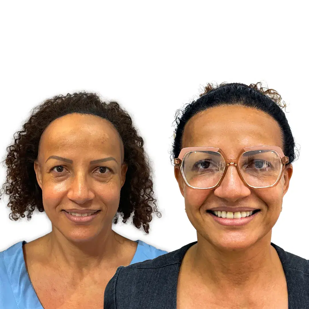 Female Hair Transplant