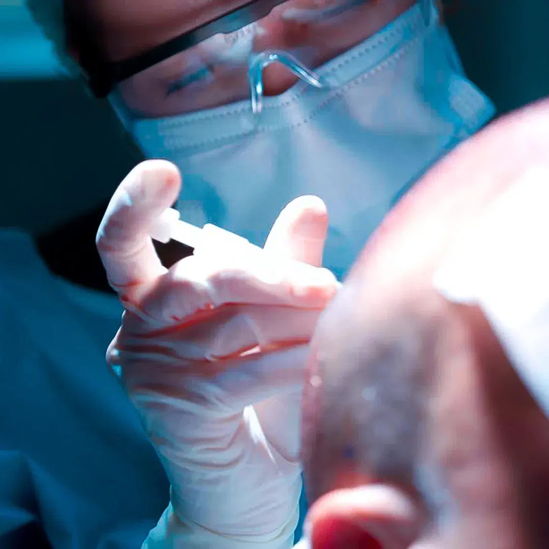 Hair Transplantation Services in Mexico