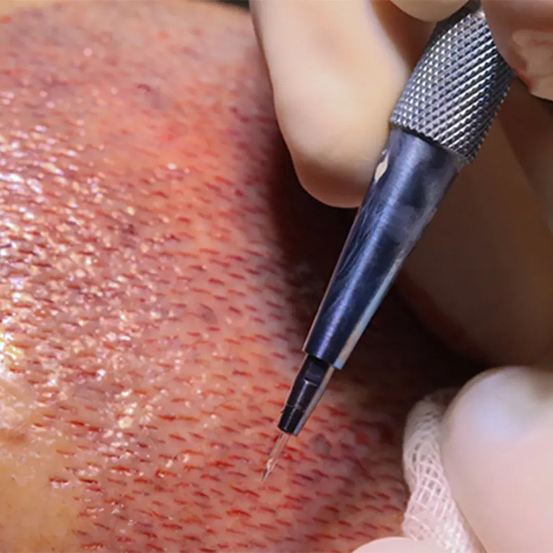 Sapphire FUE Hair Transplant