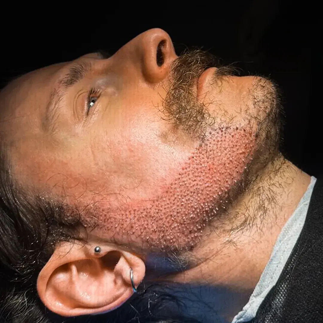 Beard Transplant