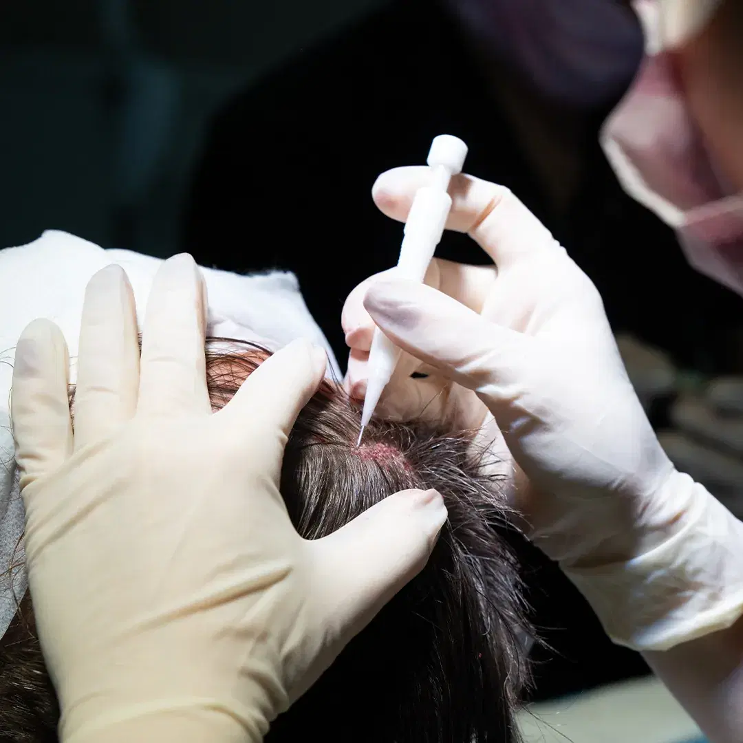 Unshaven Hair Transplant