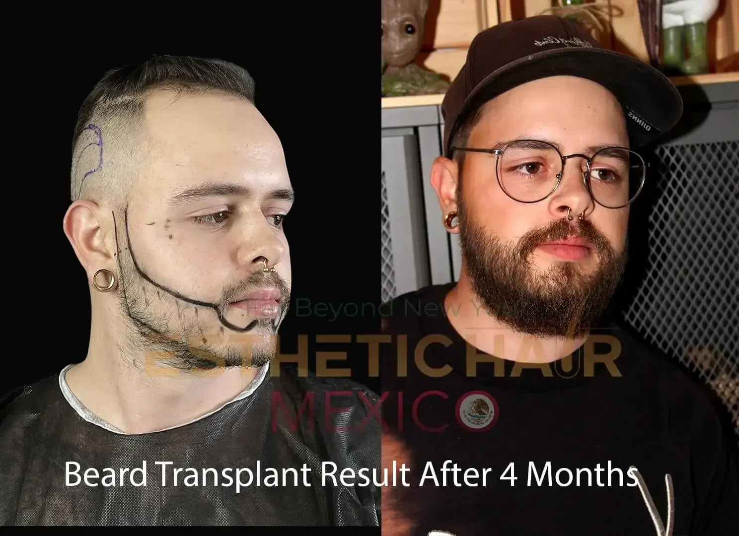 Before Beard Transplant