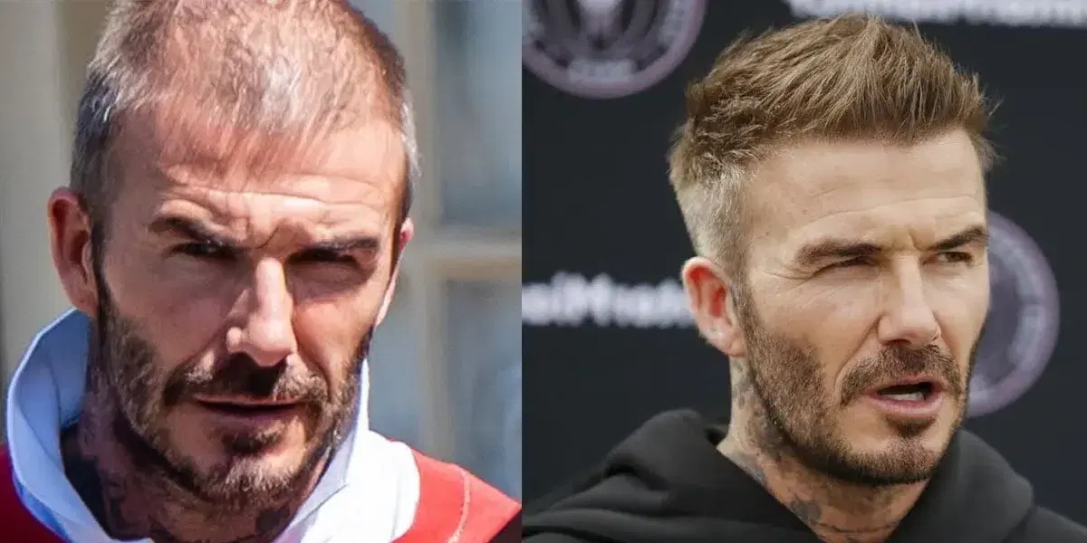 david-beckham-hair-transplant