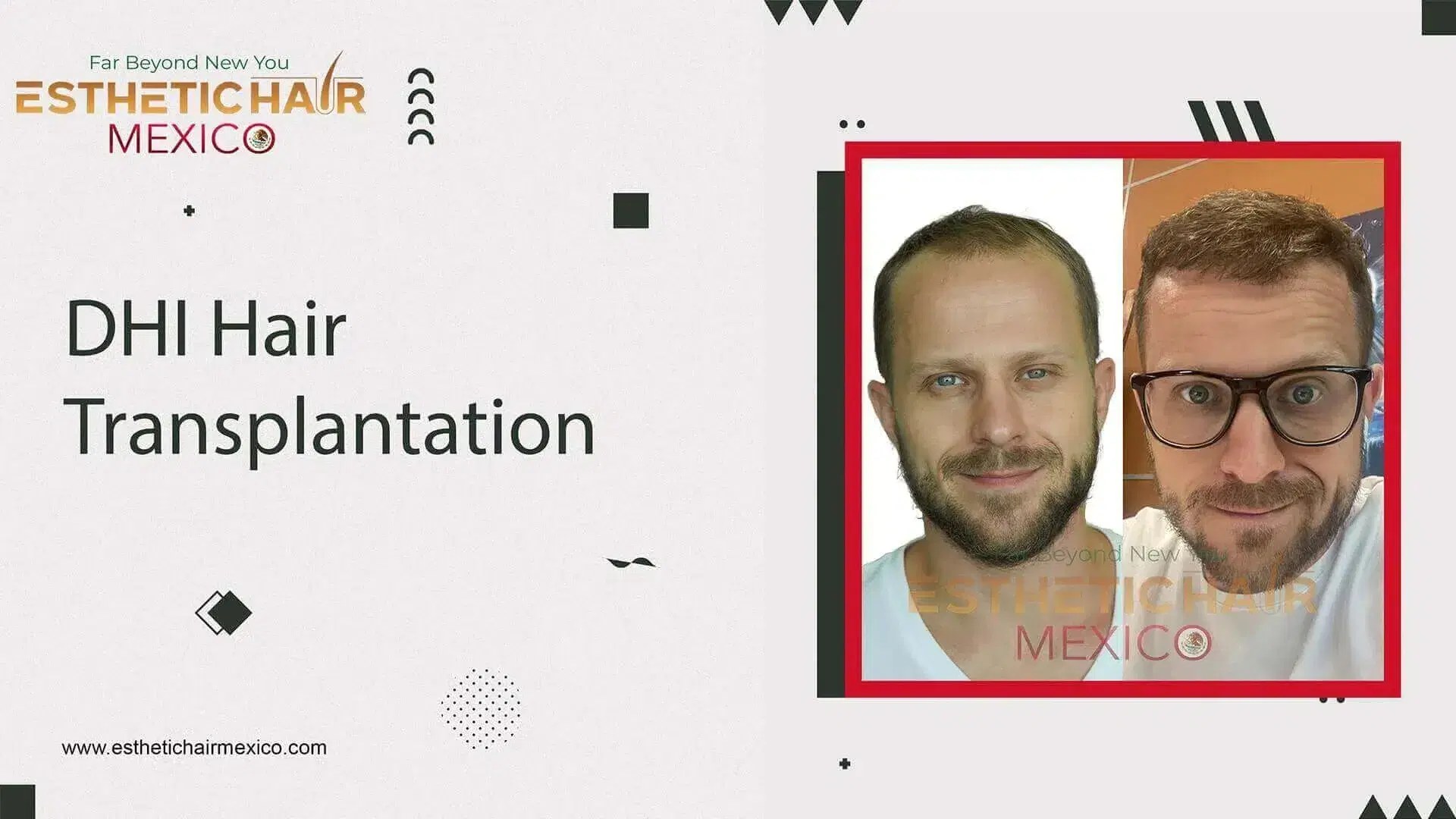 DHI Hair Transplant in Mexico