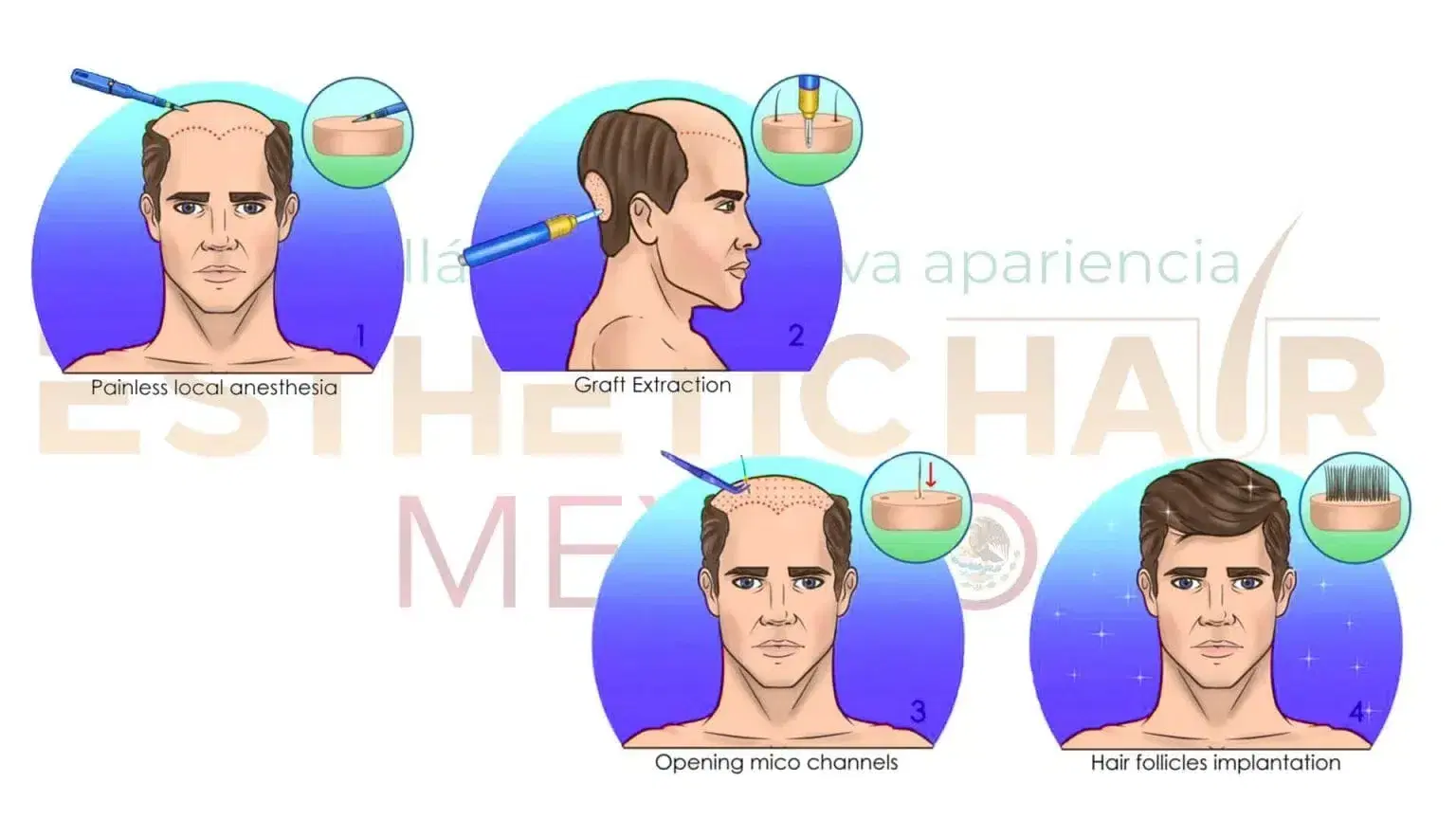 Hair Transplant Procedure Steps