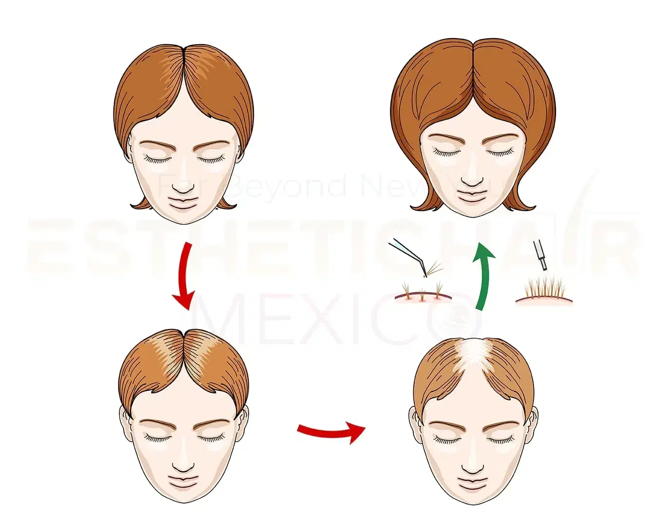 Can Unshaven Hair Transplantation Be Done?