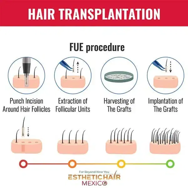 DHI Hair Transplant