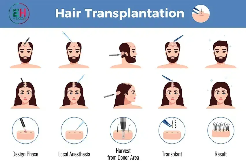 Hair Loss in Women