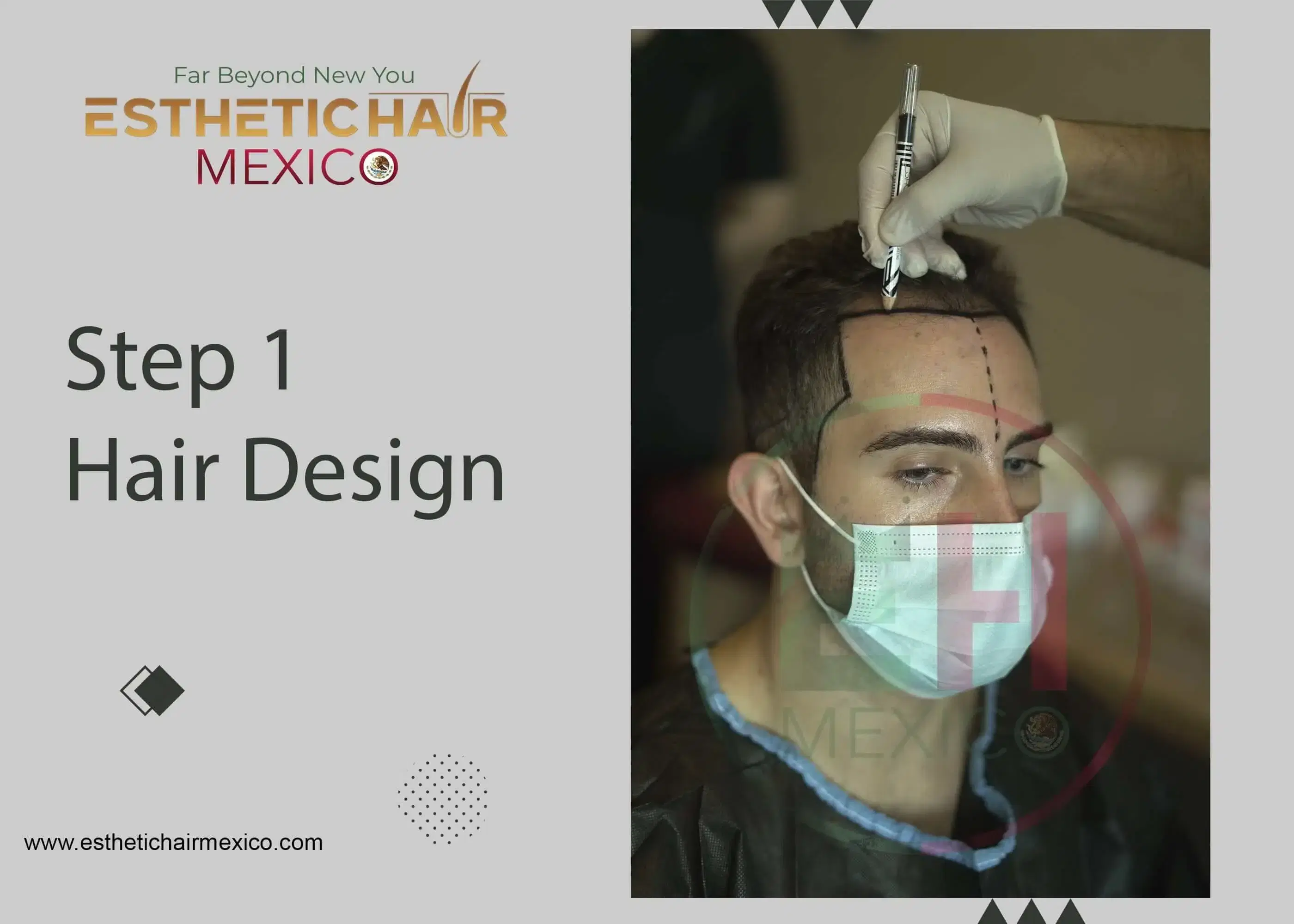 Hair Transplant Procedure Step by Step