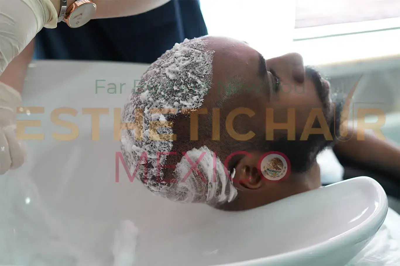 Shampoo after hair transplant