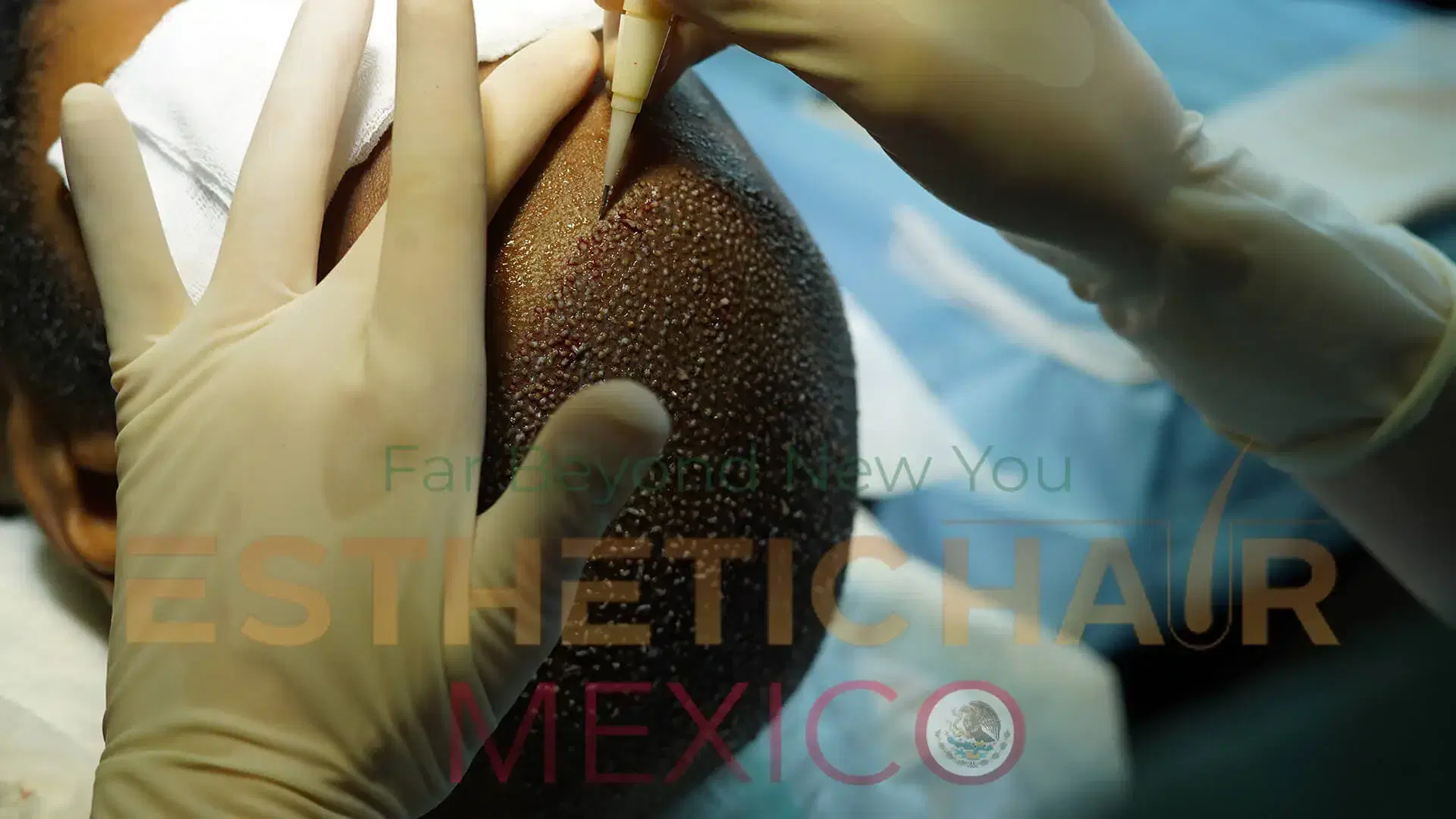 Paulo Costa's Hair Transplant Journey in Turkey Esthetic Hair Turkey Experience