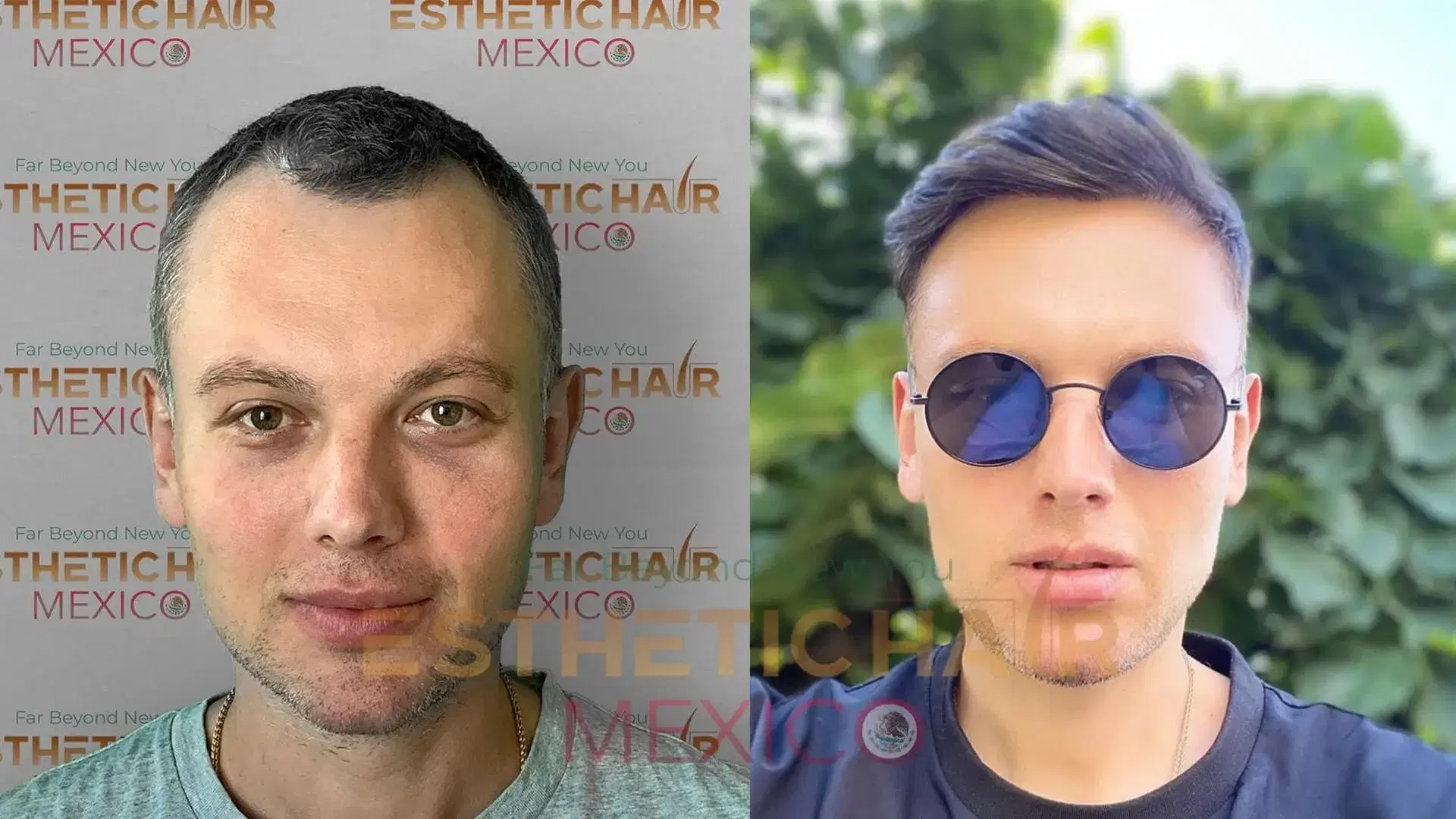 How Long Do Hair Transplant Last