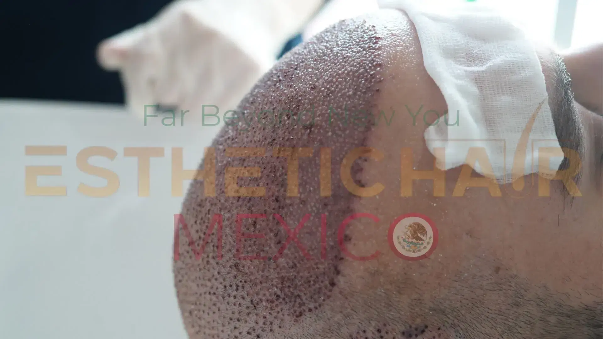 scabs-after-hair-transplant